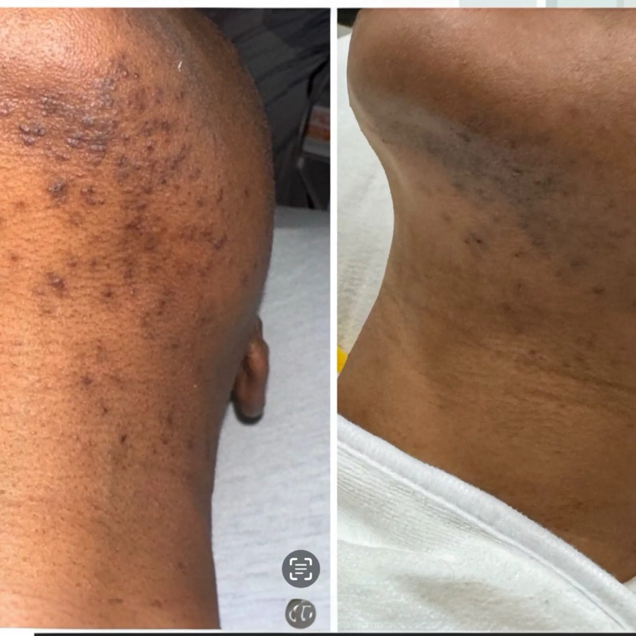 Acne Facial Pkg - Rejuvenate Your Skin Today